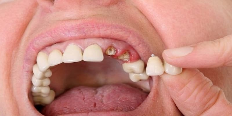 Luận giải điềm báo liên quan đến giấc mộng rụng răng giả
